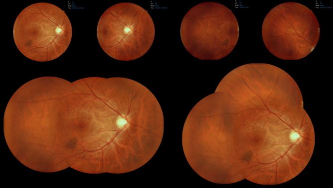 fotomontaggio fondus oculare Retinografia