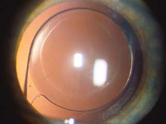 Analisi della Cataratta - Studio Silvio Spizzirri