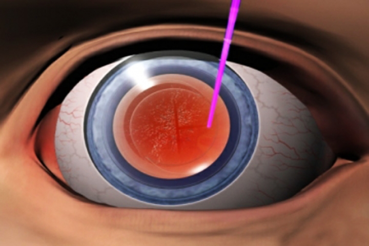 Oculistica Spizzirri a Taranto - Trattamento Cataratta 