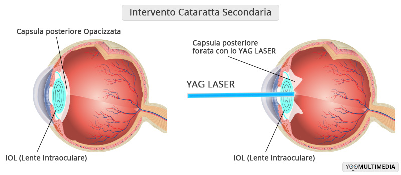 Intervento Cataratta Secondaria - Oculistica Spizzirri