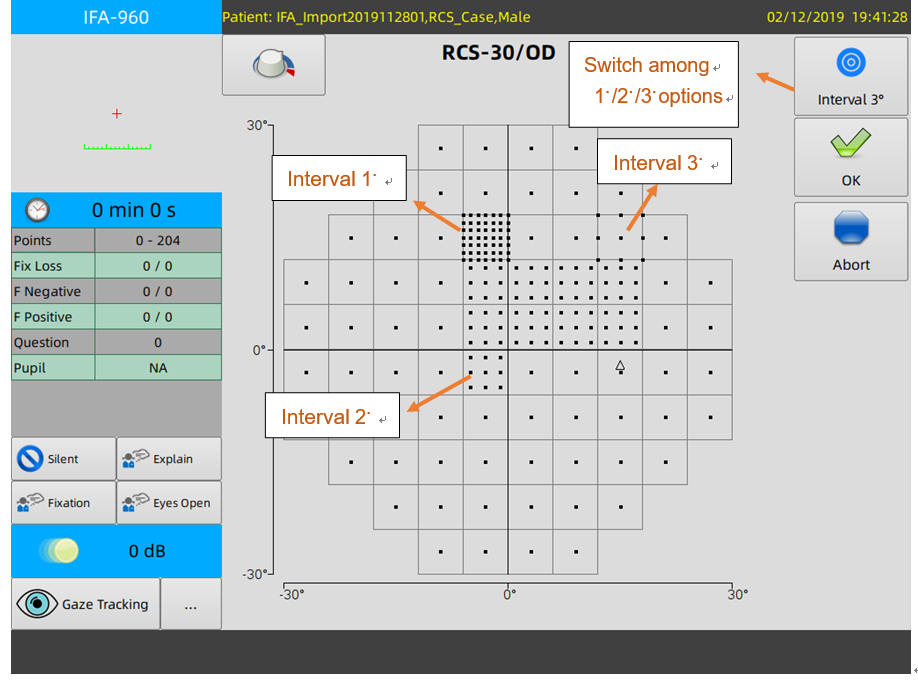 Intervento Cataratta - Diagramma