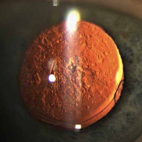 Trattamento della Cataratta - Studio Silvio Spizzirri